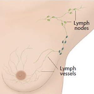 Breast Cancer Patients Will Be Spared from An Axillary Clearance if There is No Cancer Spread