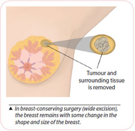 Breast Cancer Treatment Breast Cancer Surgery K W Ong Breast General Surgery K W Ong Medical Consultancy Breast General Surgery