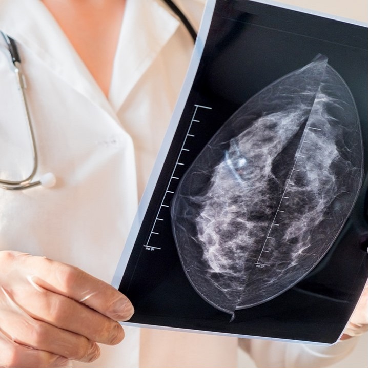 My Doctor Says I Have Dense Breasts: What Does It Mean To Have Dense Breast?