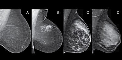 Measuring breast density